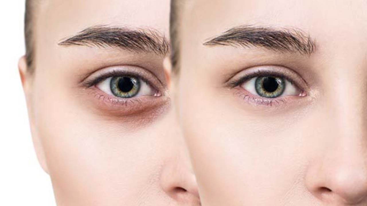 پف زیر چشم رو فوری از بین ببر! 7 روش موثر و سریع خانگی