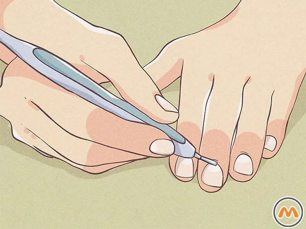 به کوتیکولهای خود دست نزنید تا از عفونت جلوگیری کنید